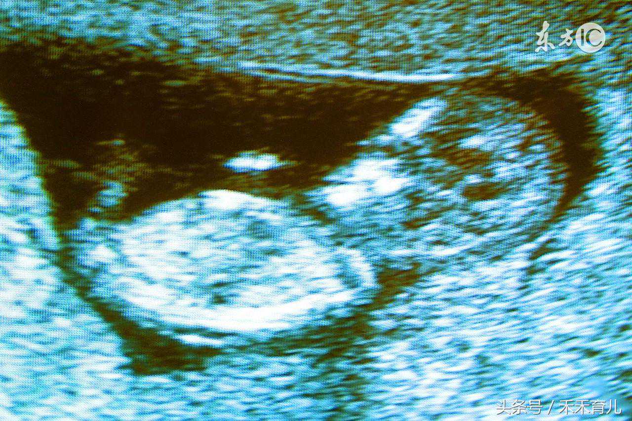 通过胎儿打嗝看男女，胎儿打嗝在左下腹是男孩？